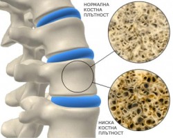 Как да разпознаем първите симптоми на остеопорозата