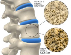 Първите симптоми на остеопорозата са трудно разпознаваеми
