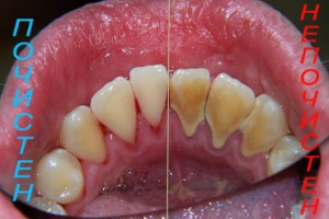 Природната аптека разполага с ефективни методи за премахване на зъбен камък