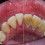 Ефективно премахване на зъбен камък в домашни условия