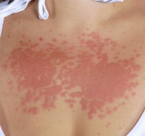 Тежката слънчева алергия може да предизвика сериозни здравословни проблеми