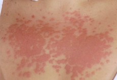 Как да се предпазим от слънчева алергия?