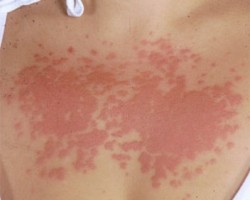 Как да се предпазим от слънчева алергия?